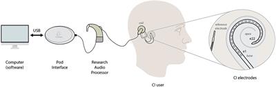 Toward Self-Measures in Cochlear Implants: Daily and “Homemade” Impedance Assessment